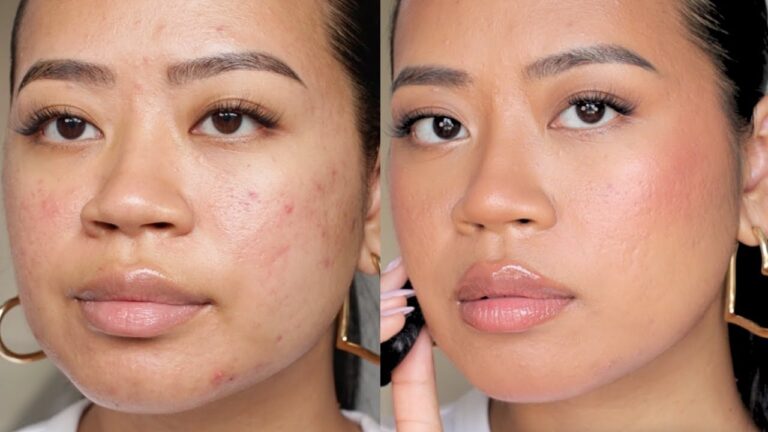 Oily or Acne-Prone Skin